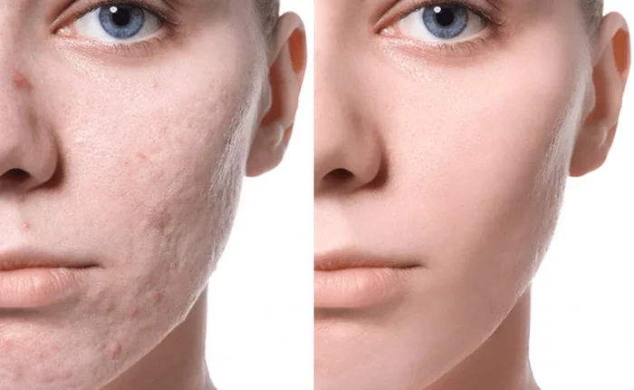 Before and After Acne Treatment