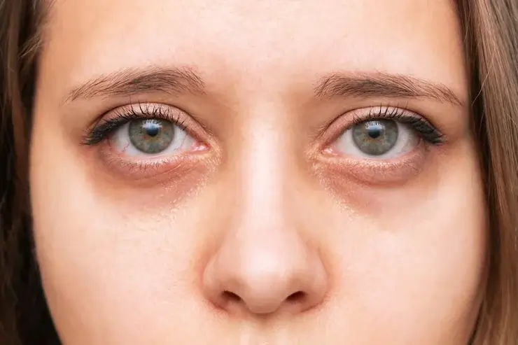 Young girl having puffy eyes